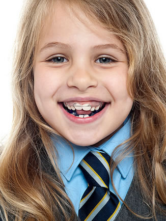 types of braces